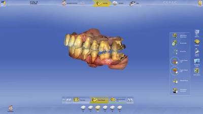 Sirona combina innovación y facilidad de uso con el nuevo software dental CEREC 4.3